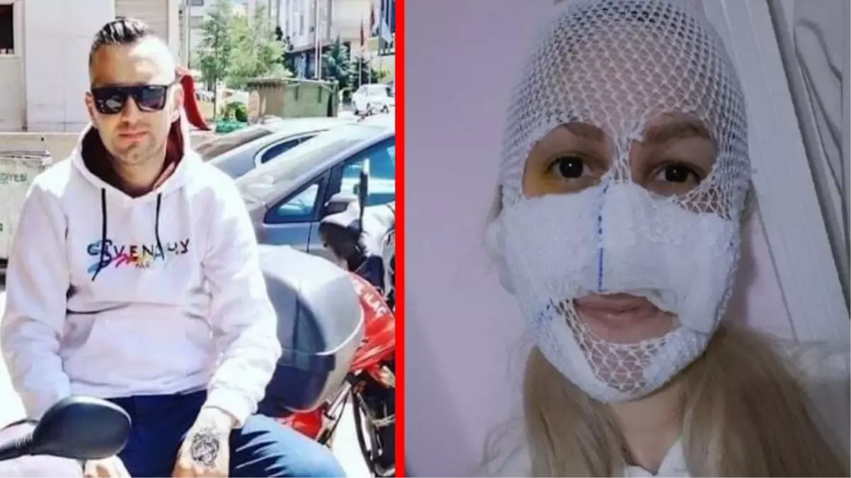Eski sevgilisi tarafından yüzüne kezzap atılan kadın konuştu: Onun ev hapsi bitti, benimki başladı