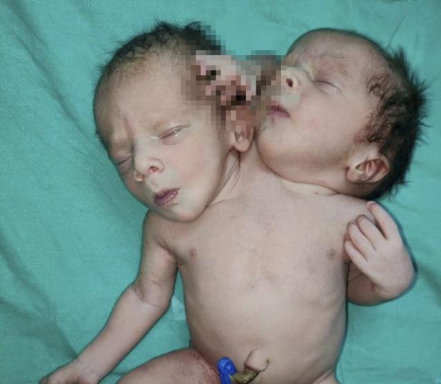Doğumhane kapısında ikiz bebek bekliyorlardı, çift başlı bebeği görünce lisanları tutuldu