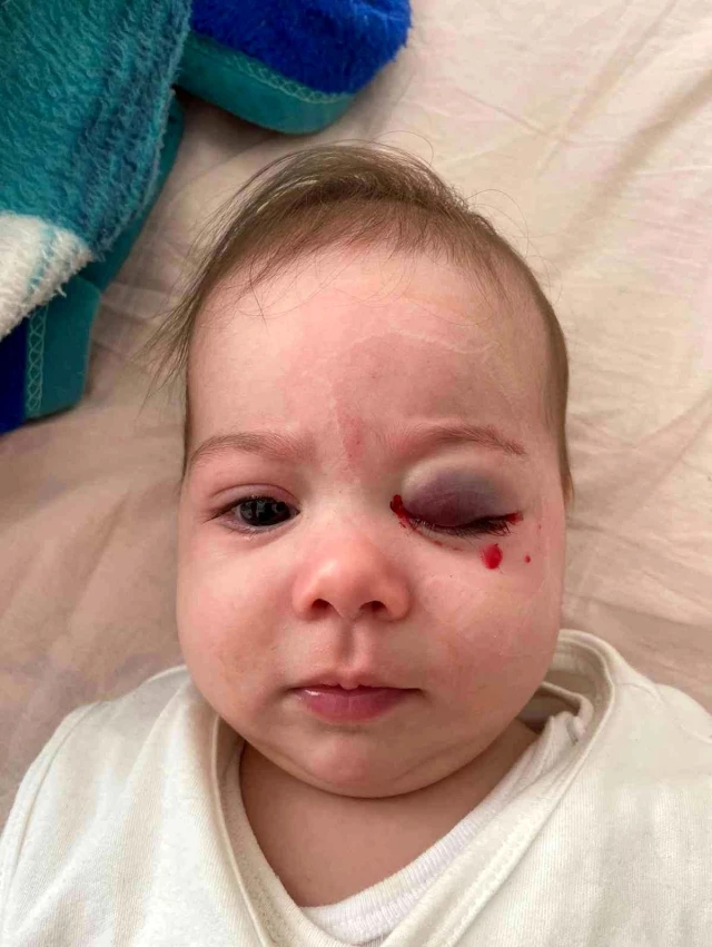 Göz kapağından ameliyat olan 7 aylık bebek bu hale geldi