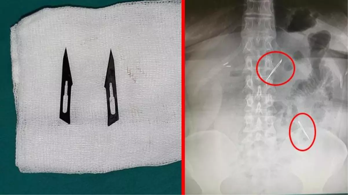 Karın ağrısı şikayetiyle gitti, 2 tane neşter yuttuğunu öğrendi