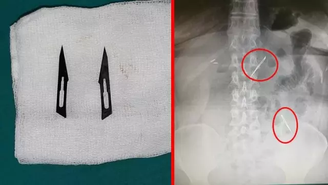 Karın ağrısı şikayetiyle gitti, 2 tane neşter yuttuğunu öğrendi