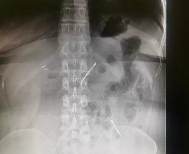 Karın ağrısı şikayetiyle gitti, 2 tane neşter yuttuğunu öğrendi