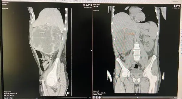 Halsizlik şikayetiyle gitti, karnından 20 santimlik kitle çıkarıldı Halsizlik şikayetiyle gitti, karnından 20 santimlik kitle çıkarıldı