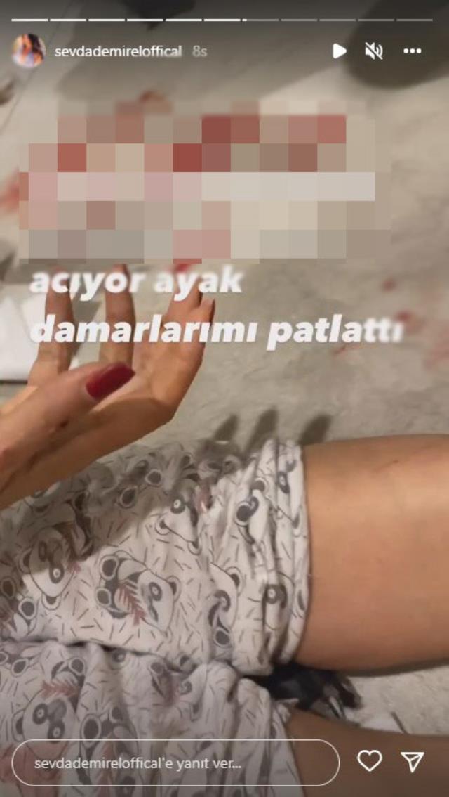 Anne kedinin saldırdığı Sevda Demirel'in damarları patladı Anne kedinin saldırdığı Sevda Demirel'in damarları patladı