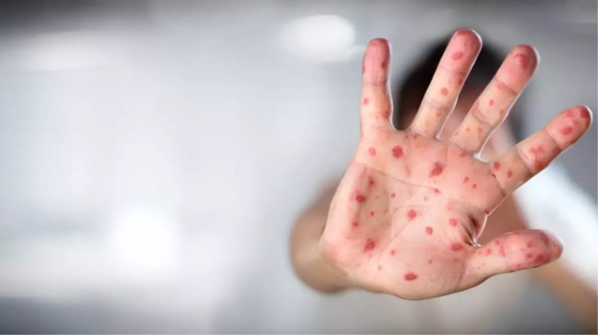 Dünya Sağlık Örgütü: 11 ülkede toplam 80 maymun çiçeği vakası tespit edildi, 50 vaka inceleme altında