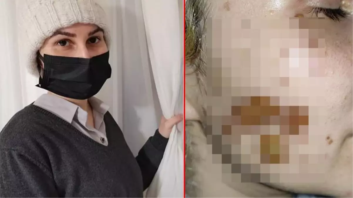 Adli tıp: Yüzüne kimyasal atılan Sultan'ın yaraları sabit iz niteliğinde