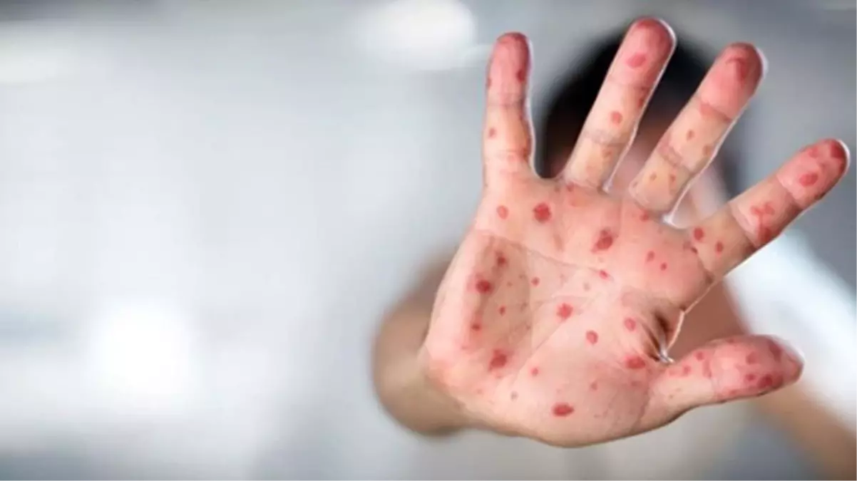 İngiltere'den gelen son veriler endişelendirdi! Maymun çiçeği virüsü hızla yayılıyor