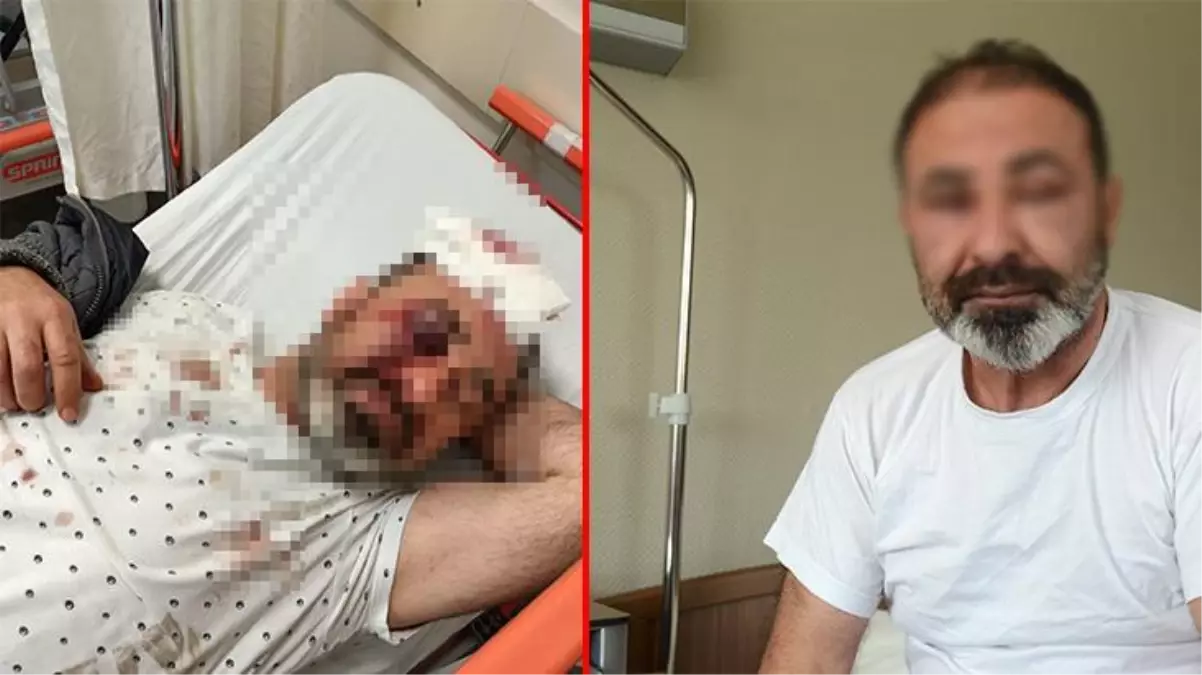 Kavgayı ayırırken gözüne yumruk isabet eden şahsın retinası parçalandı