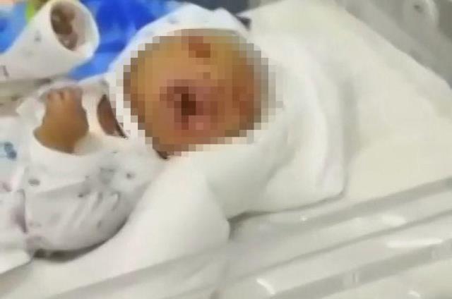 Kalıtımsal hastalıkla doğan bebek hastaneyi alarma geçirdi, yüzünü gören doktorlar dehşete kapıldı