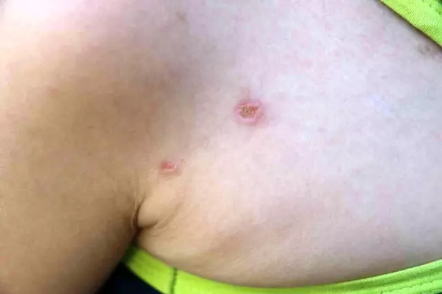 Küçük çocuğun vücudunda sigara söndürüldü; eski eşler birbirini suçluyor