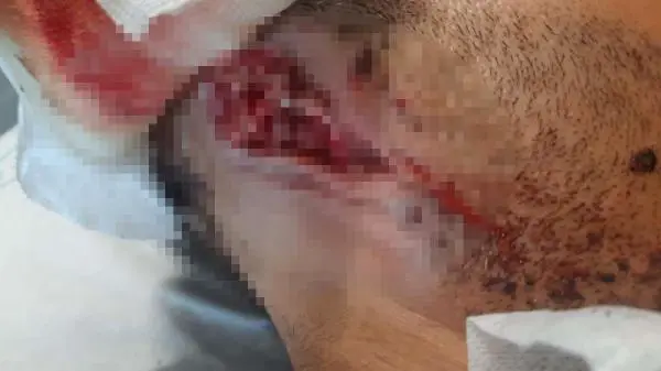 İstanbul'da pitbullu saldırı faillerinden 2'si serbest bırakıldı: Kardeşimin kulağını kaybetme ihtimali yüzde 90 İstanbul'da pitbullu saldırı faillerinden 2'si serbest bırakıldı: Kardeşimin kulağını kaybetme ihtimali yüzde 90