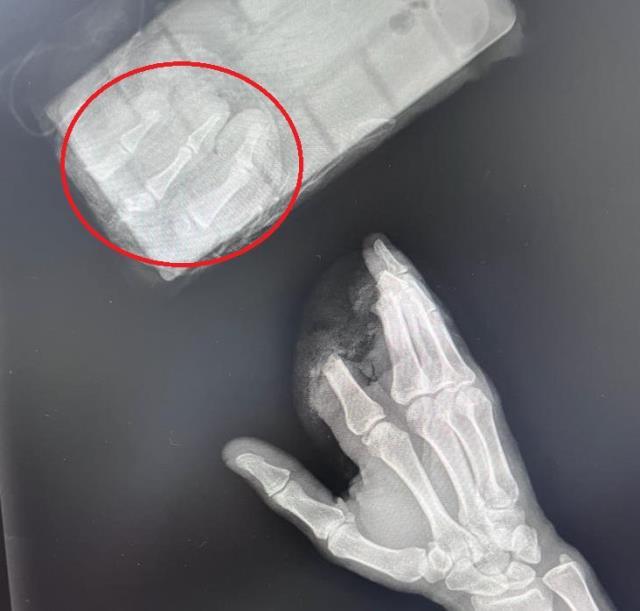 Elini giyotin makasına kaptırdı, kopan parmaklarını poşetle hastaneye götürdü Elini giyotin makasına kaptırdı, kopan parmaklarını poşetle hastaneye götürdü