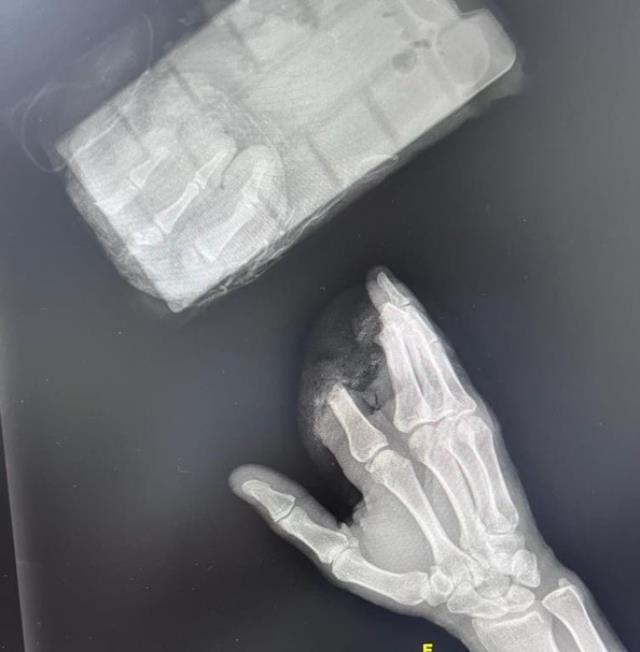 Kopan 3 parmağını poşete koydu hastaneye koştu, ameliyatla sağlığına kavuştu Kopan 3 parmağını poşete koydu hastaneye koştu, ameliyatla sağlığına kavuştu