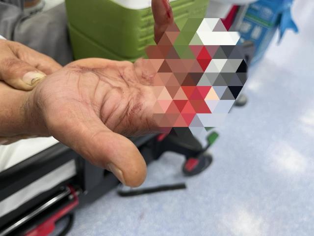 Kopan 3 parmağını poşete koydu hastaneye koştu, ameliyatla sağlığına kavuştu Kopan 3 parmağını poşete koydu hastaneye koştu, ameliyatla sağlığına kavuştu