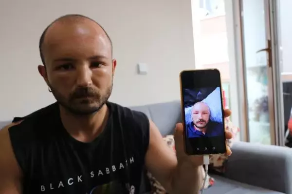 2 gün plaja gitti, başında nadir görülen sıcak ödemi oluştu