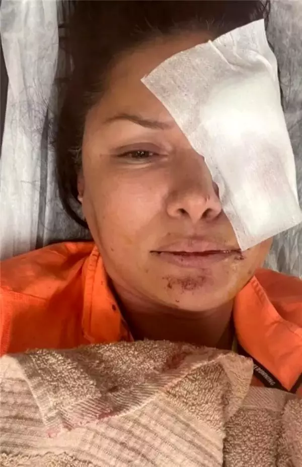 Ünlü manken Tuğba Altıntop'un yüzünü köpek ısırdı! Son durumu çok üzücü Ünlü manken Tuğba Altıntop'un yüzünü köpek ısırdı! Son durumu çok üzücü