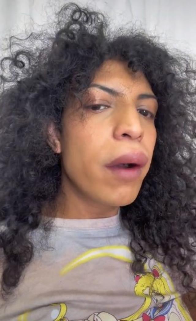 Sevgilisiyle öpüştükten sonra dudağı şişen kadın hastaneye zor yetişti Sevgilisiyle öpüştükten sonra dudağı şişen kadın hastaneye zor yetişti