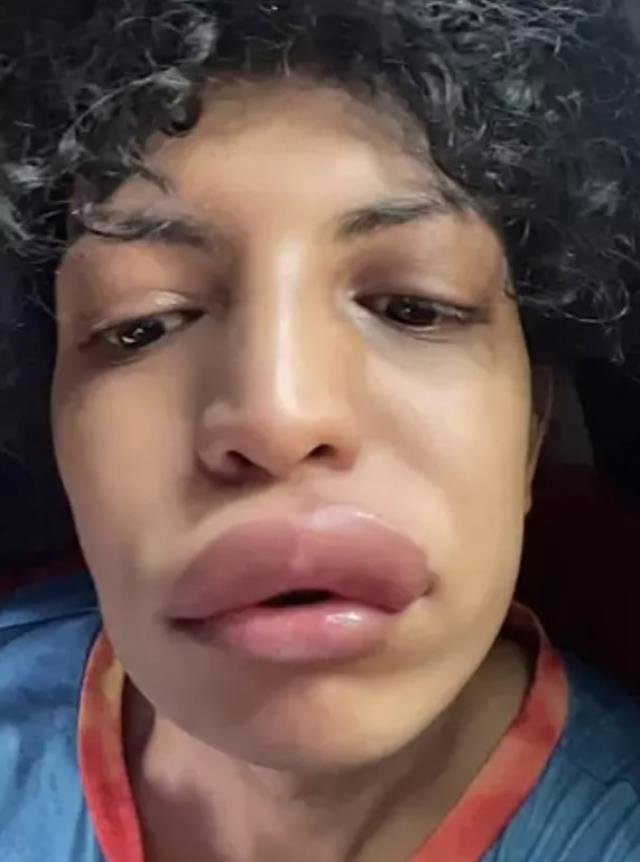 Sevgilisiyle öpüştükten sonra dudağı şişen kadın hastaneye zor yetişti