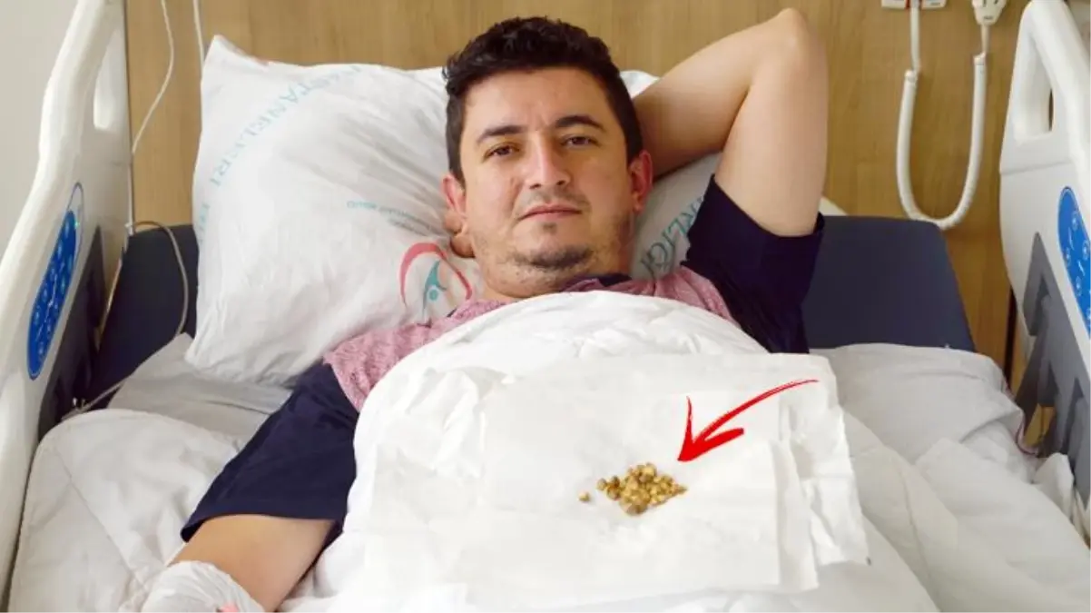 6 ayda 2 operasyon geçiren hastanın mesanesinden 66 adet taş alındı