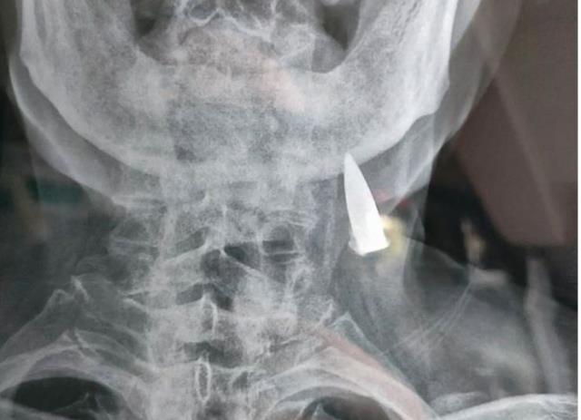 Baş ağrısıyla hastaneye giden 95 yaşındaki adamın röntgeni doktorları hayrete düşürdü