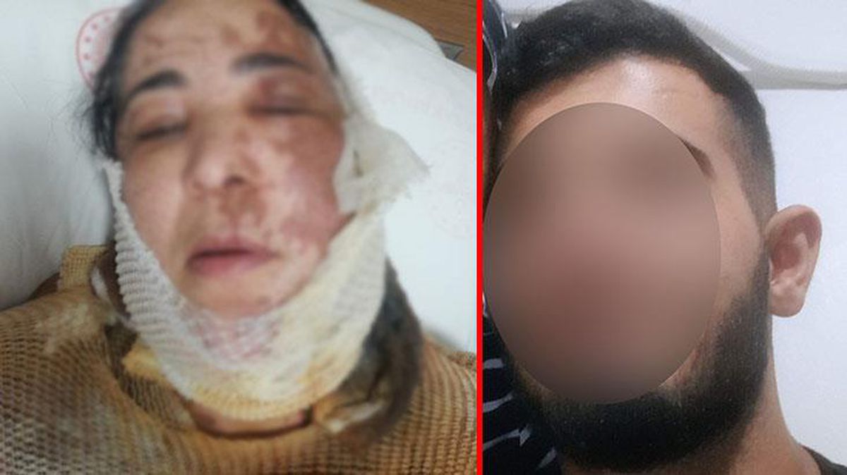Bu nasıl vahşet! Üvey annesinin üzerine kimseyle evlenemesin diye kezzap döktü