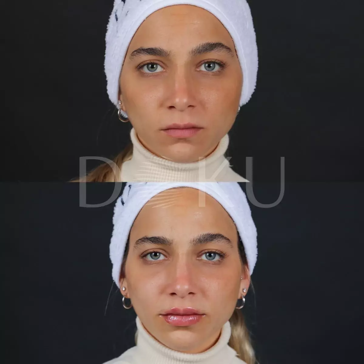 Doku Medical - Dudak Dolgusu ve Burun Dolgusu Uygulamaları Ameliyat Gerektirir Mi?