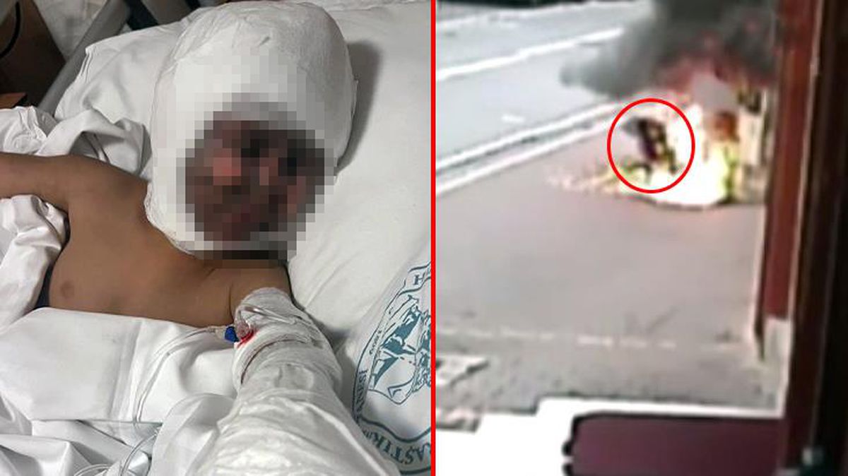 Elektrik trafosu 4 yaşındaki çocuğun yüzünde bomba gibi patladı