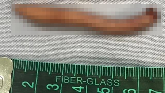 Tıp dünyasını şaşırtan olay! Meksika'da bir bebek 5.7 santim kuyrukla dünyaya geldi