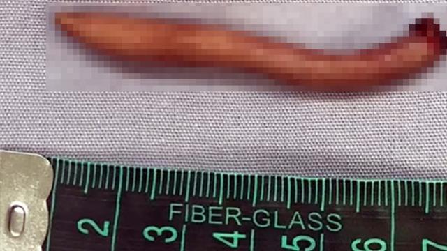 Tıp dünyasını şaşırtan olay! Meksika'da bir bebek 5.7 santim kuyrukla dünyaya geldi
