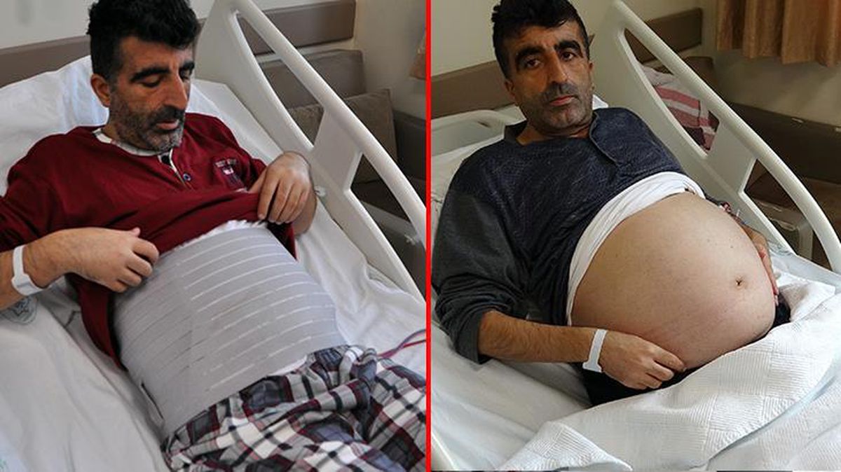 Kilo aldığını sanan adamın karnından çıkanlara doktorlar bile inanamadı