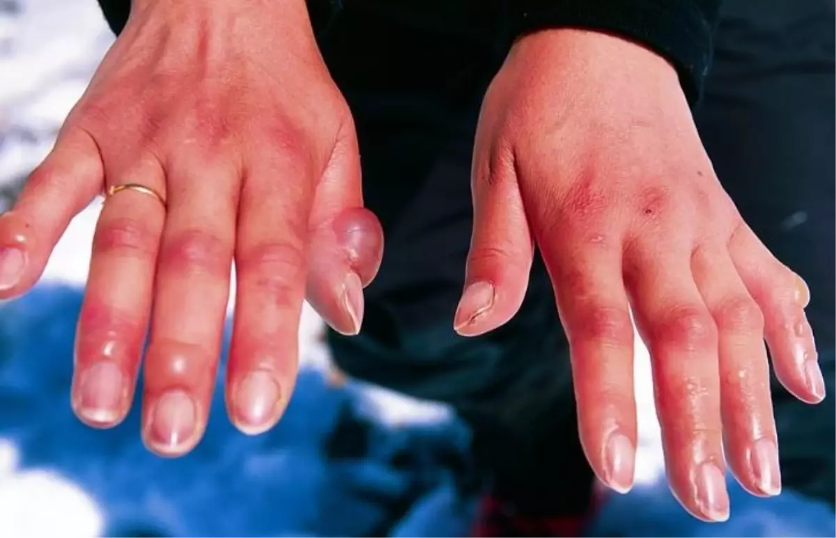 Soğuk ısırması nedir? Soğuk ısırığı belirtileri nelerdir? Soğuk ısırması nasıl anlaşılır?