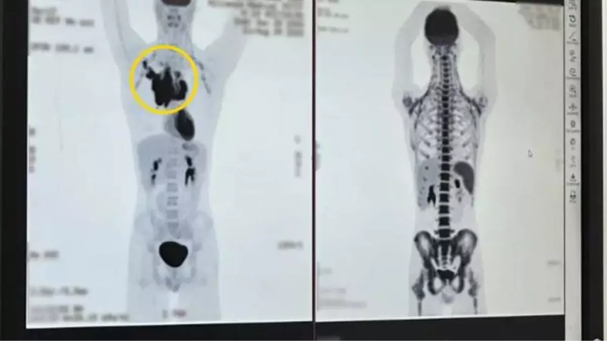 Omzundan 'Tık' diye ses duyan genç, hastaneye gittiğinde kanser olduğunu öğrendi