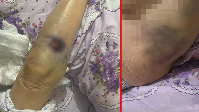 Başkent'te bakıcı dehşeti: 91 yaşındaki yaşlı kadın hastanede ölüm kalım savaşı veriyor