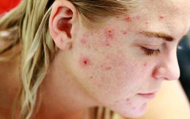 Rüyada sivilce görmek ne anlama gelir? Rüyada yüzde sivilce görmek nedir? Rüyada yüzde sivilce çıktığını görmek ne demek?