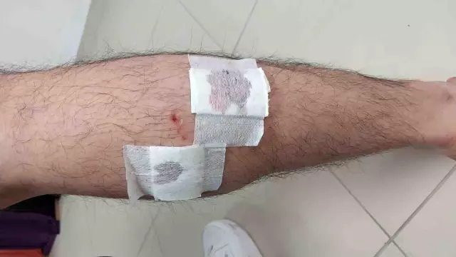 Mersin'de sokak köpekleri belediye çalışanına saldırıp ısırdı