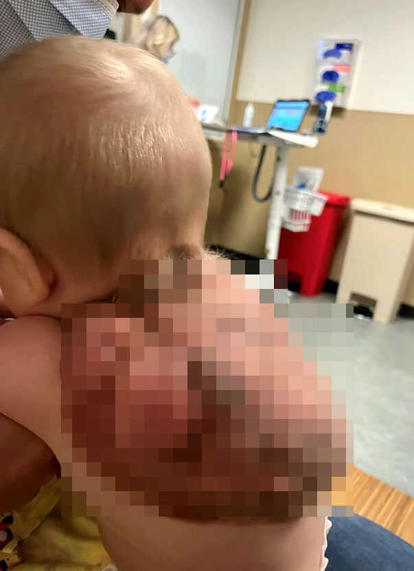 Küçük çocuk sırtında şimdiye dek görülmemiş yumruyla dünyaya geldi! 'Kaplumbağa' lakabını taktılar