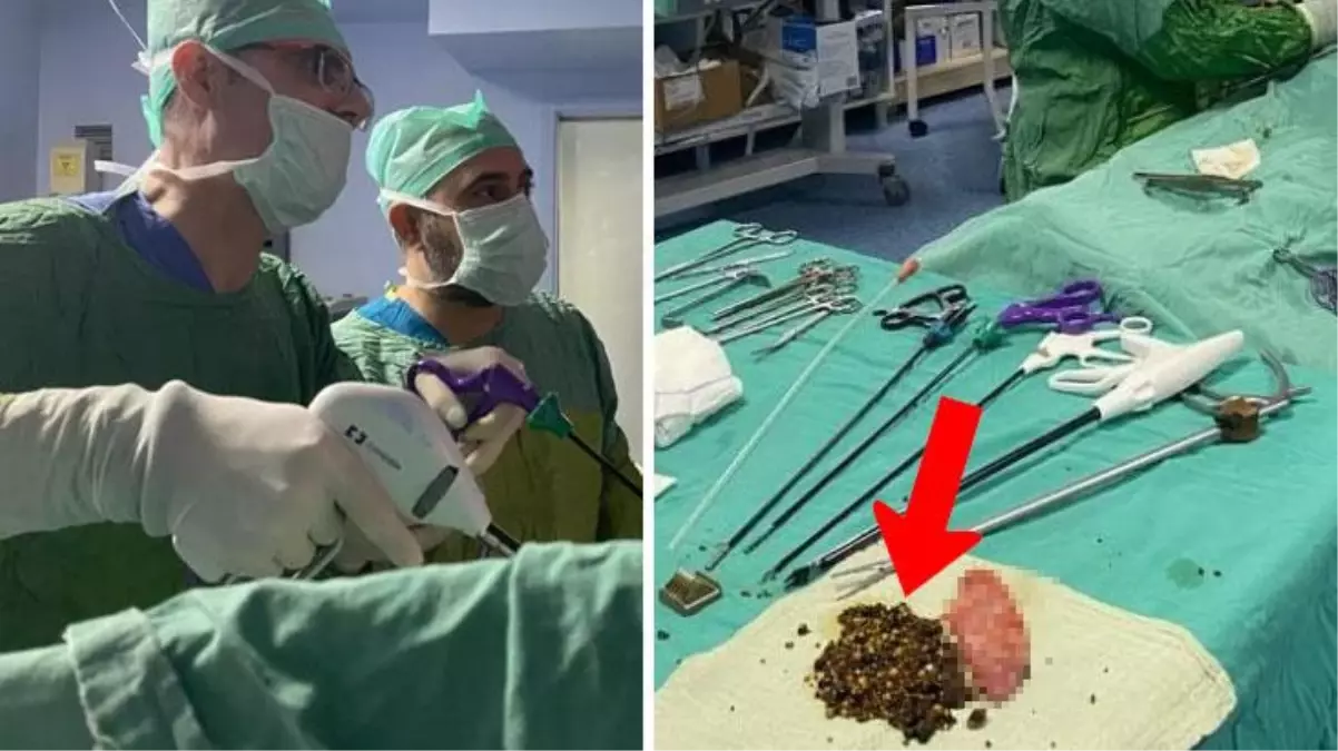 Doktor, güçlükle ikna ettiği hastanın safra kesesinden 2 bin adet taş çıkardı