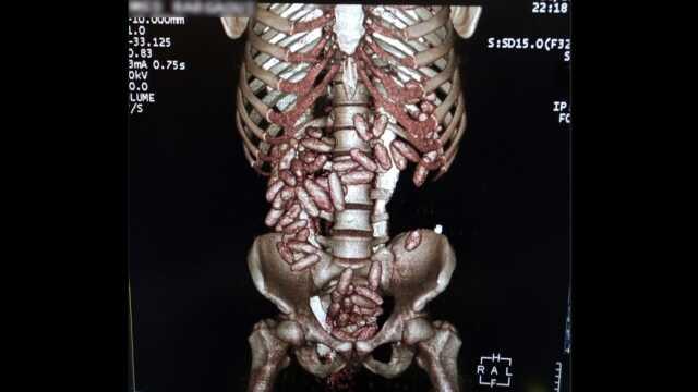 İstanbul Havalimanı'nda kuryelik yapan yolcunun midesinde 820 gram kokain ele geçirildi İstanbul Havalimanı'nda kuryelik yapan yolcunun midesinde 820 gram kokain ele geçirildi