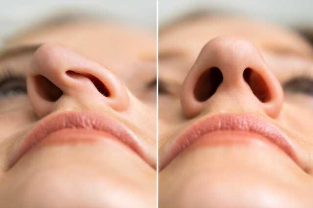 How much is a septorhinoplasty in Türkiye? Achieve Improved Nasal Function and Aesthetic Harmony with Septorhinoplasty