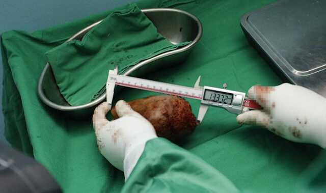 Bir insandan çıkarılan en büyük böbrek taşı! Guinness Dünya Rekorlarına girdi Bir insandan çıkarılan en büyük böbrek taşı! Guinness Dünya Rekorlarına girdi