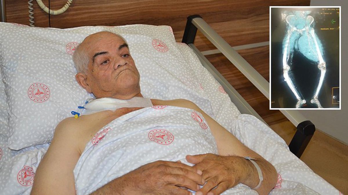 Ayakları ağrıdığı için hastaneye gitti, uyluk kemiğinden 9 kiloluk tümör çıktı