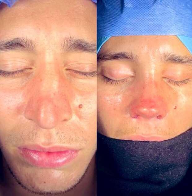 Emre Mor'un burnuna ne oldu? Emre Mor burun estetiği mi yaptırdı? Emre Mor'un burnuna ne oldu? Emre Mor burun estetiği mi yaptırdı?