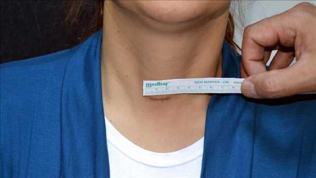 Guatr nedir, belirtileri neler? Zehirsiz guatr belirtileri ve zehirli guatr belirtileri nedir? Guatr tedavisi nedir? Guatr nedir, belirtileri neler? Zehirsiz guatr belirtileri ve zehirli guatr belirtileri nedir? Guatr tedavisi nedir?