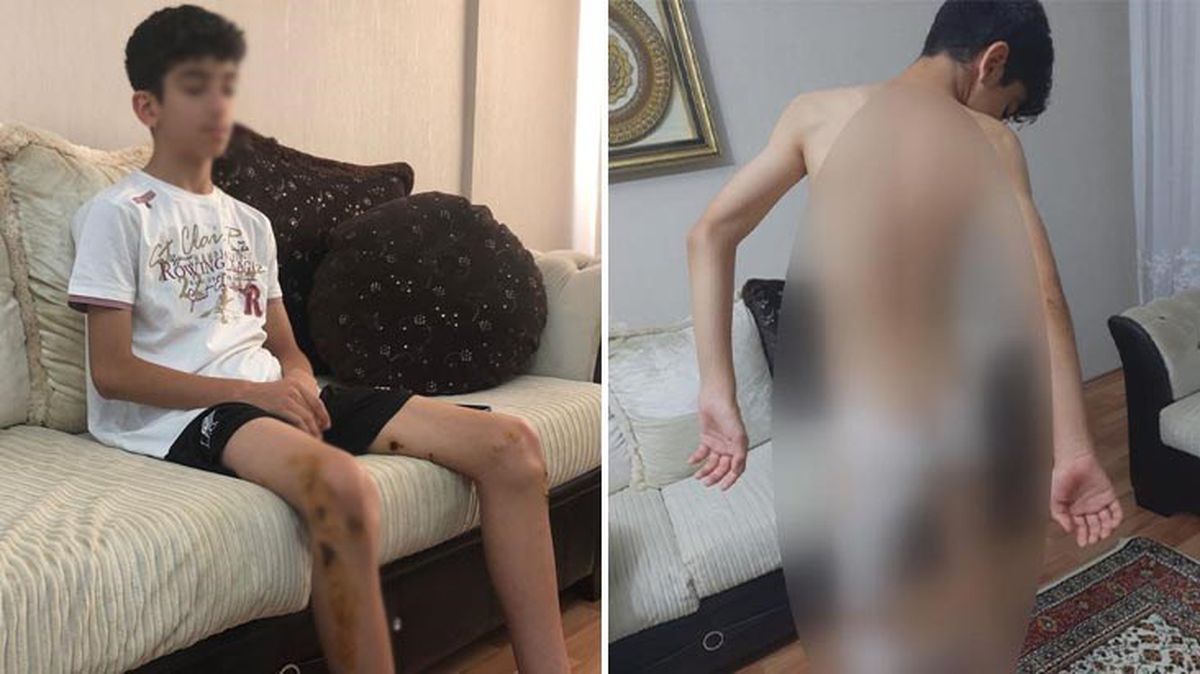 Ankara'da başıboş köpekler küçük çocuğu 8 yerinden ısırdı! Korkudan dışarı çıkamıyor