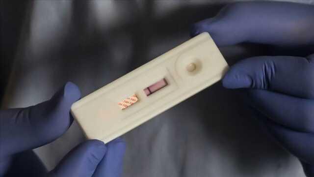 Zona bulaşıcı mı? Zona hastalığı nedir, belirtileri nelerdir? Zona bulaşıcı mı? Zona hastalığı nedir, belirtileri nelerdir?