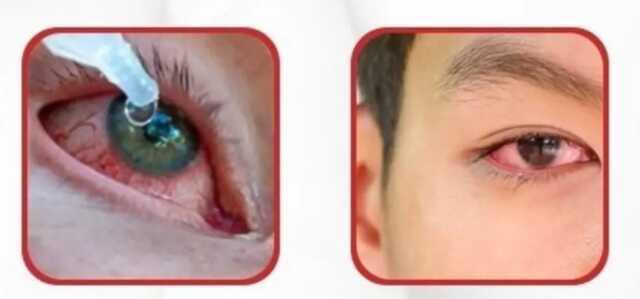 Pakistan'da 'kırmızı göz' alarmı! Vaka sayılarının patlaması sonrasında okullar tatil edildi Pakistan'da 'kırmızı göz' alarmı! Vaka sayılarının patlaması sonrasında okullar tatil edildi