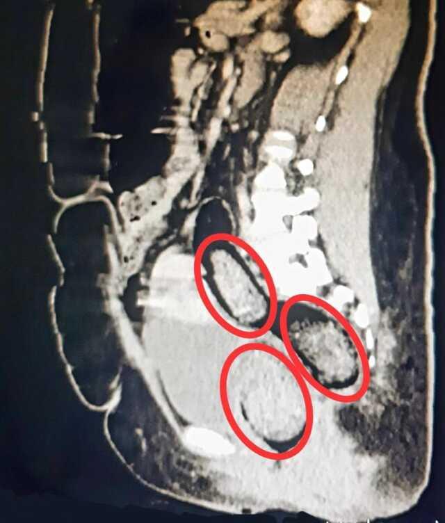 İran uyruklu yolcunun makatından uyuşturucu çıktı İran uyruklu yolcunun makatından uyuşturucu çıktı