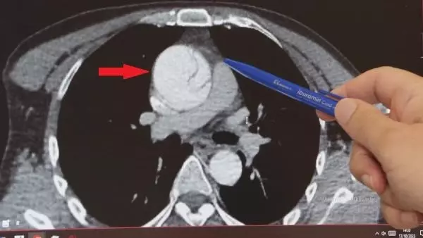Aort damarı yırtılan hastayı 'Mide ağrısı' deyip eve yolladılar! Doktorun ihmali az kalsın canına mal oluyordu Aort damarı yırtılan hastayı 'Mide ağrısı' deyip eve yolladılar! Doktorun ihmali az kalsın canına mal oluyordu