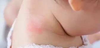 Morfea nedir, nasıl olur? Morfea nasıl geçer?