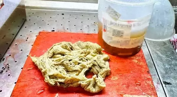 Doğum Sonrası Unutulan Gazlı Bez 2 Yıl Sonra Çıkarıldı Doğum Sonrası Unutulan Gazlı Bez 2 Yıl Sonra Çıkarıldı